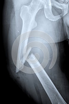 X-ray