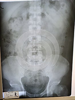 X-ray Abdomen ileus medical doctors