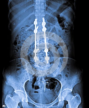 X Ray of Abdomen with lumbar spine