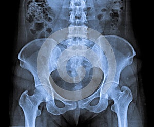 X Ray abdomen and pelvic.