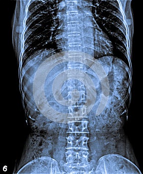 X Ray abdomen showing spine.