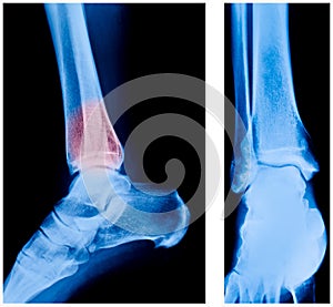 X-ray of the ankle