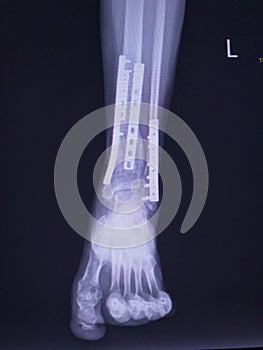 X-ray Ankle joint AP Case fracture distal metaphysis of distal tibia and fibula.Post ORIF with plate and screws.Medical image co photo