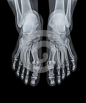 X Ray of Ankle joint front view.