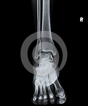 X Ray of Ankle joint front view.