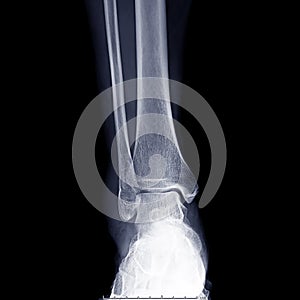 X-ray ankle joint or Radiographic image or x-ray image of right ankle joint photo