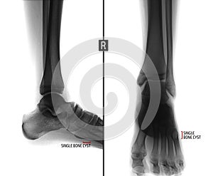 X-ray of the ankle joint. Shows the bony cyst of the fifth finger of the right foot. Marker. Negative.