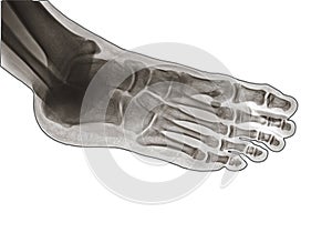 X Ray of Ankle joint side view.