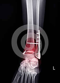 X -ray ankle with Plate and screw
