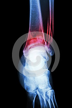 x-ray ankle show fracture distal tibia and fibula (leg's bone) photo