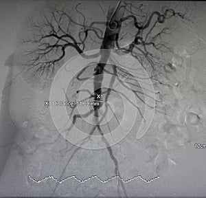 X-ray of Aorta, abdominal vessels photo