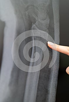 X-ray of the arm bone. Radiologist examines the crack