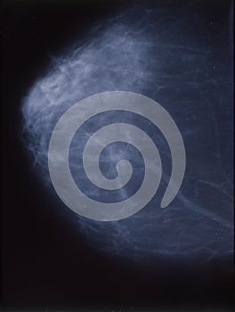 mammography of the female breast photo