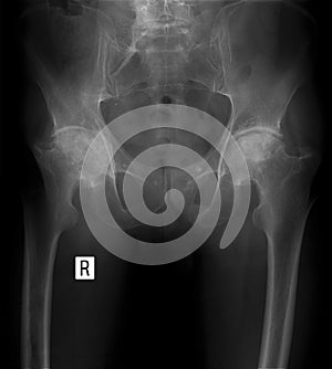 X-ray. Bilateral deforming osteoarthritis of the hip joints.