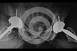 X-Ray of bilateral hip prosthesis