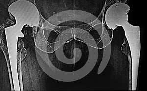 X-Ray of bilateral hip prosthesis