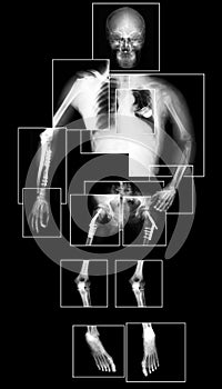 X-ray body