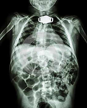 X-ray body of child and tracheostomy tube