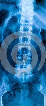 X-ray of the bones of the human lower lumbar part of the vertebral column