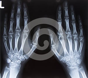 X-ray of both hands, Black background