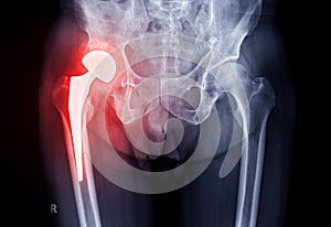 x-ray Both hip  ap view showing Right hip replacement or hip prosthesis made from titanium