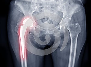 X-ray Both hip joint  ap view showing Right hip replacement