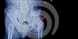 X-Ray Both Hips No fracture and dislocation ,Normal joint space  finding Aseptic necrosis.on red arrow point