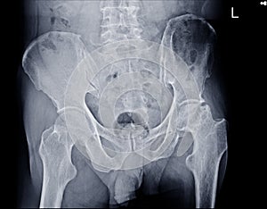 X-ray Both hips and Pelvis showing Flattening and cystic change left femur head with normal joint space.Medical image concept