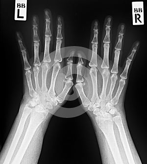 X-ray of both human hands.Normal human hands.