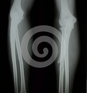 X-ray of both human legs