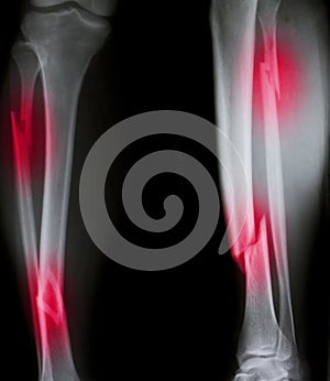 X-ray of both human legs