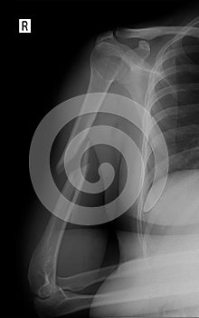 X-ray of the brachial bone. Helical humeral fracture.