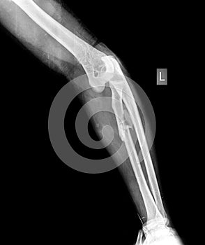 X-ray of broken arm