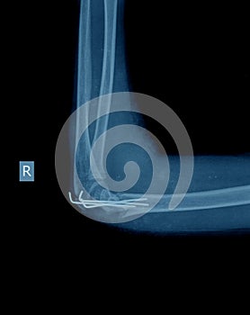 X-ray of broken arm with