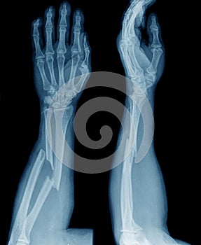 X-ray of broken arm