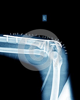 X-ray of broken arm with