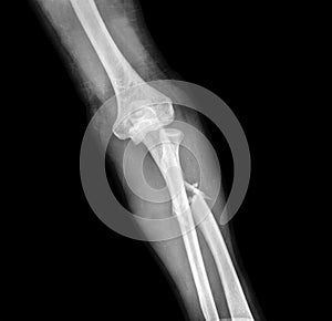 X-ray of broken arm