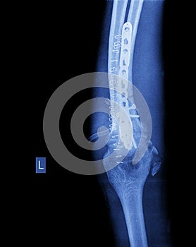 X-ray of broken arm with