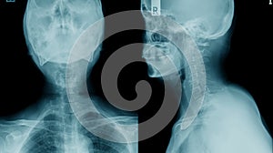 X-ray c-spine, case cervical spondylosis