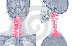 X-ray C-spine or x-ray image of Cervical spine AP and Lateral view for diagnostic intervertebral disc herniation ,Spondylosis and