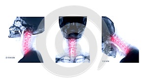 X-ray C-spine or x-ray image of Cervical spine Lateral extension ,AP and Flexion view