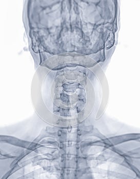 X-ray C-spine or x-ray image of Cervical spine lateral view for diagnostic intervertebral disc herniation ,Spondylosis and