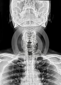 X-ray C-spine or x-ray image of Cervical spine lateral view for diagnostic intervertebral disc herniation ,Spondylosis and