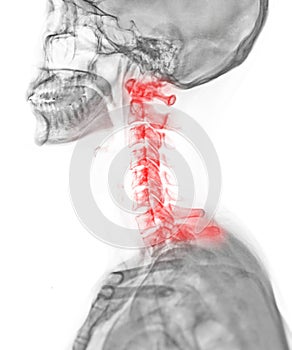 X-ray C-spine or x-ray image of Cervical spine lateral view for diagnostic intervertebral disc herniation ,Spondylosis and