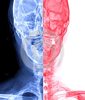 X-ray C-spine or x-ray image of Cervical spine open mount  view for  fracture of cervical vertebra 2nd ( axis