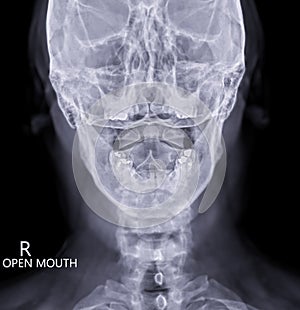 X-ray C-spine or x-ray image of Cervical spine open mount  view for  fracture of cervical vertebra 2nd ( axis