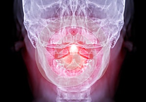 X-ray C-spine or x-ray image of Cervical spine open mount  view for  fracture of cervical vertebra 2nd ( axis