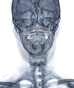 X-ray C-spine or x-ray image of Cervical spine open mount  view for  fracture of cervical vertebra 2nd ( axis