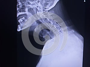 X-ray C-SpineAPLoss lordosis curve.Paravertebral calcification include facet joint indicate ankylosing spondylosis.Normal aligam