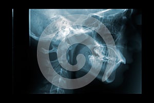 X-ray of the cervical spine. Film x-ray c-spine (Lateral view) : Cervical level spine.